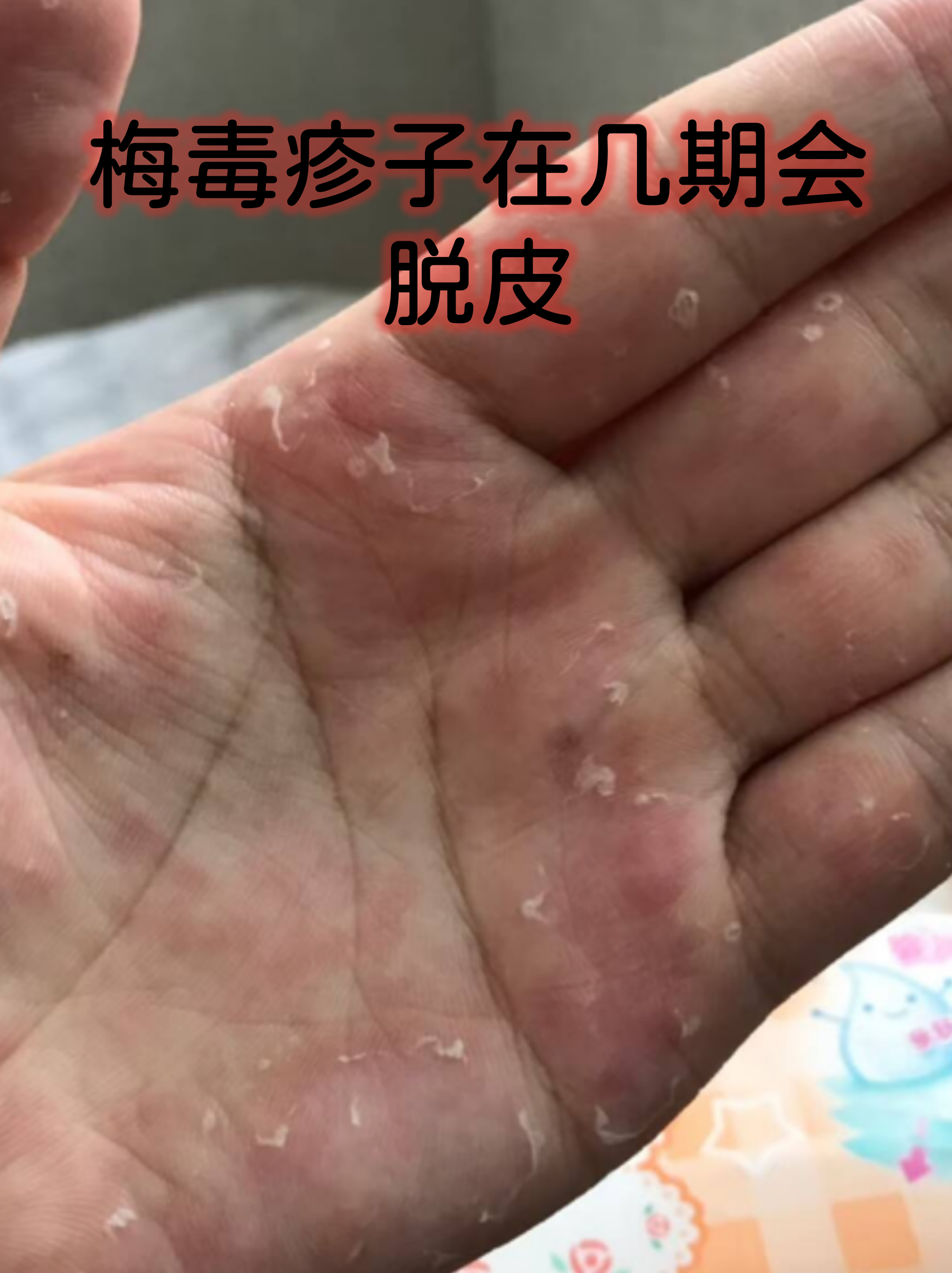 梅毒疹子在几期会脱皮
