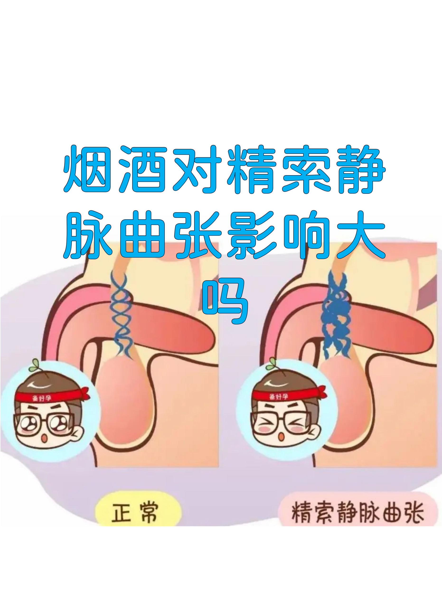 烟酒对精索静脉曲张影响大吗