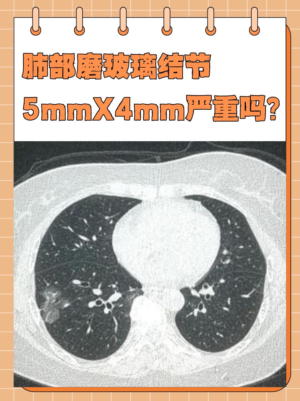 肺磨玻璃结节6mm图片