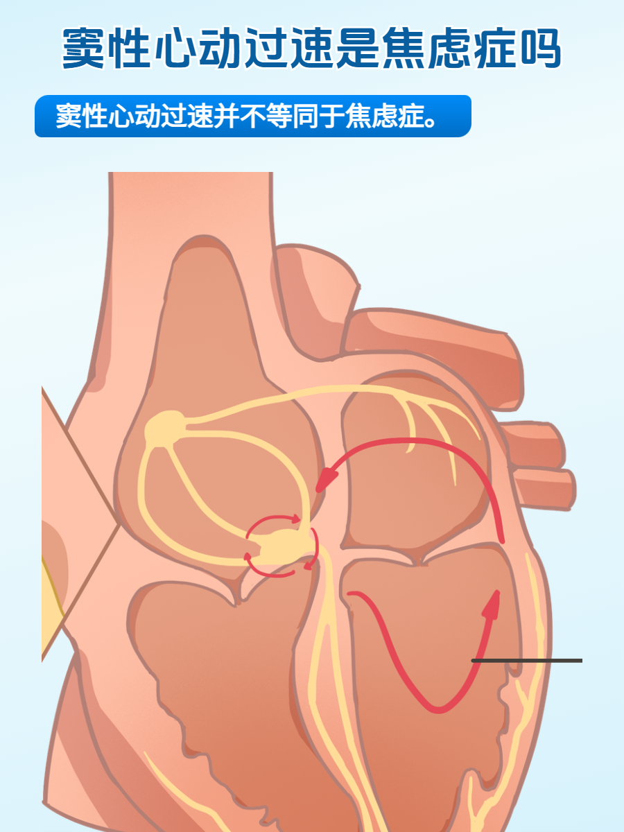 窦性心律不齐图解图片