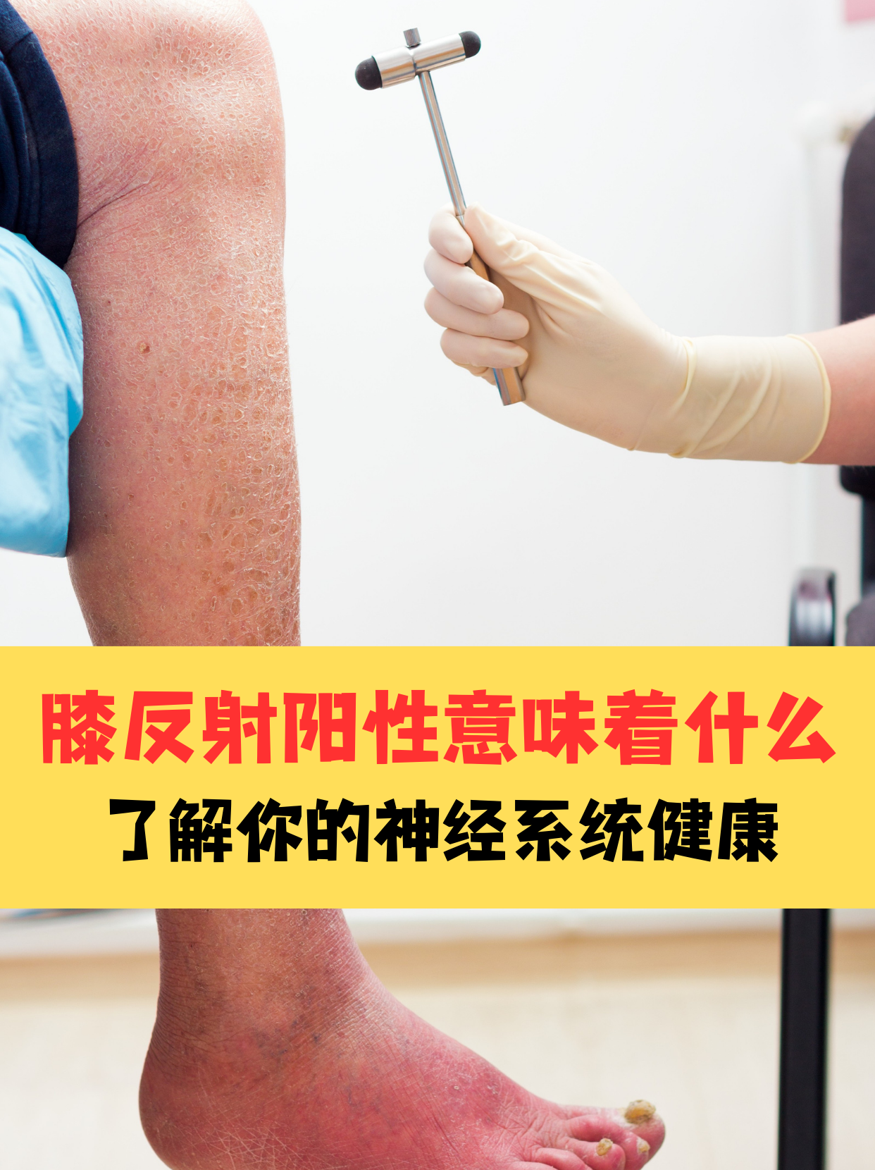 在医学检查中,膝反射(也称为膝跳反射)是一种常见的神经系统检查方法