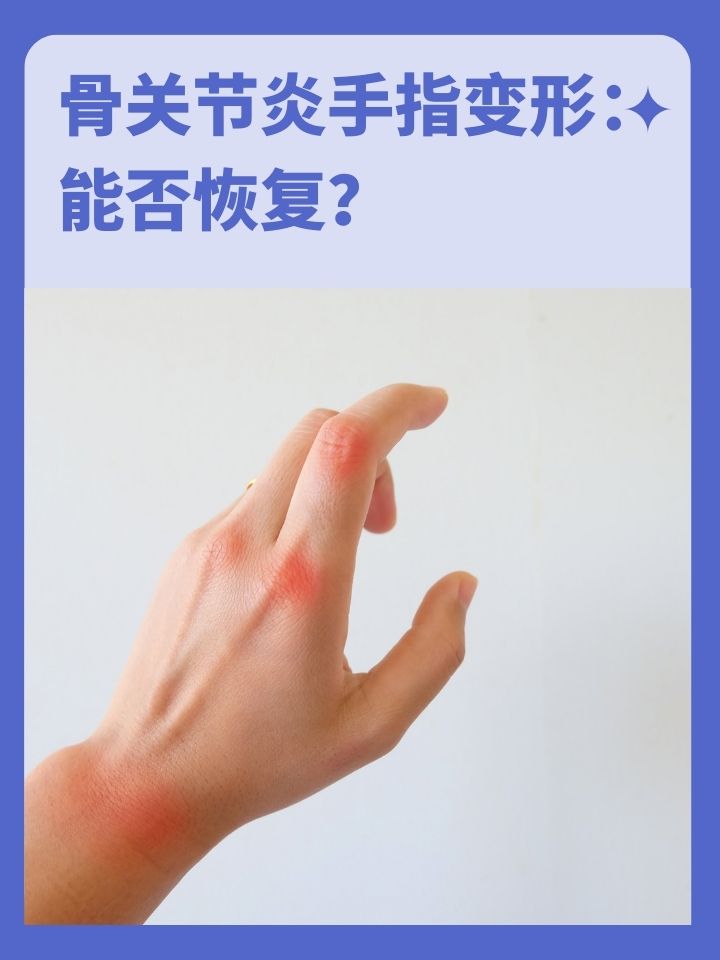 骨关节炎手指变形:能否恢复正常?