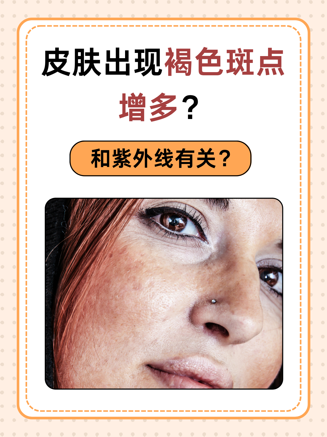 紫外线确实是导致皮肤褐色斑点增多的一个重要因素,但除此之外,还有