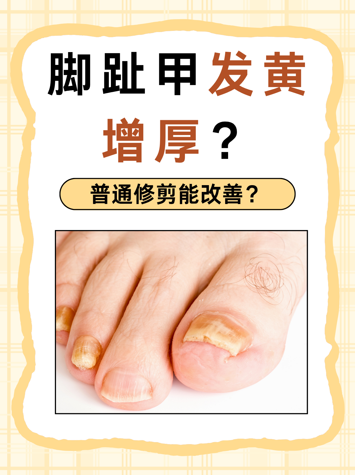 脚趾甲发黄增厚?普通修剪能改善?