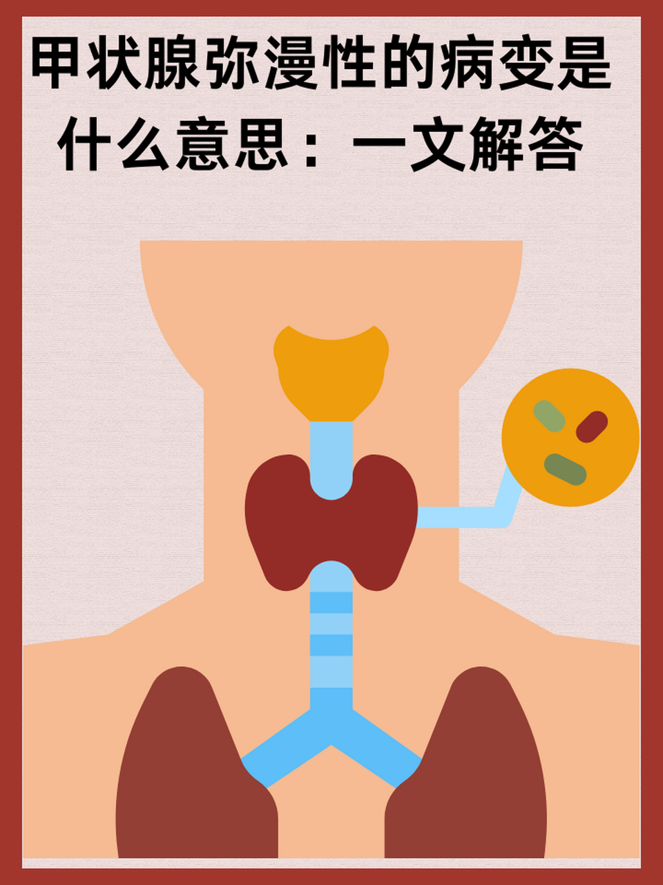 97甲状腺弥漫性的病变是什么意思:一文解答 67甲状腺弥漫性病变指