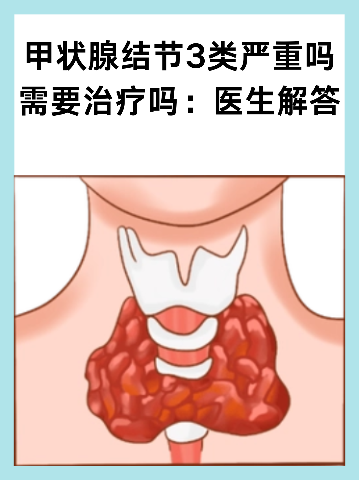 甲状腺结节根据超声表现分为五类,其中3类结节被认为是中等可疑结节