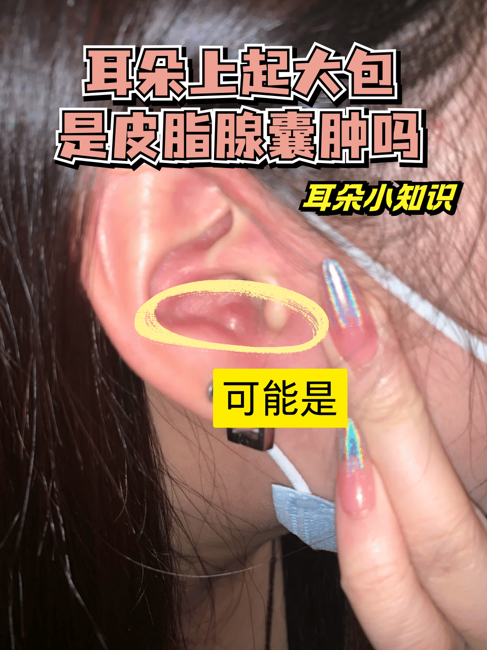 耳朵小知识:耳朵上起大包是皮脂腺囊肿吗