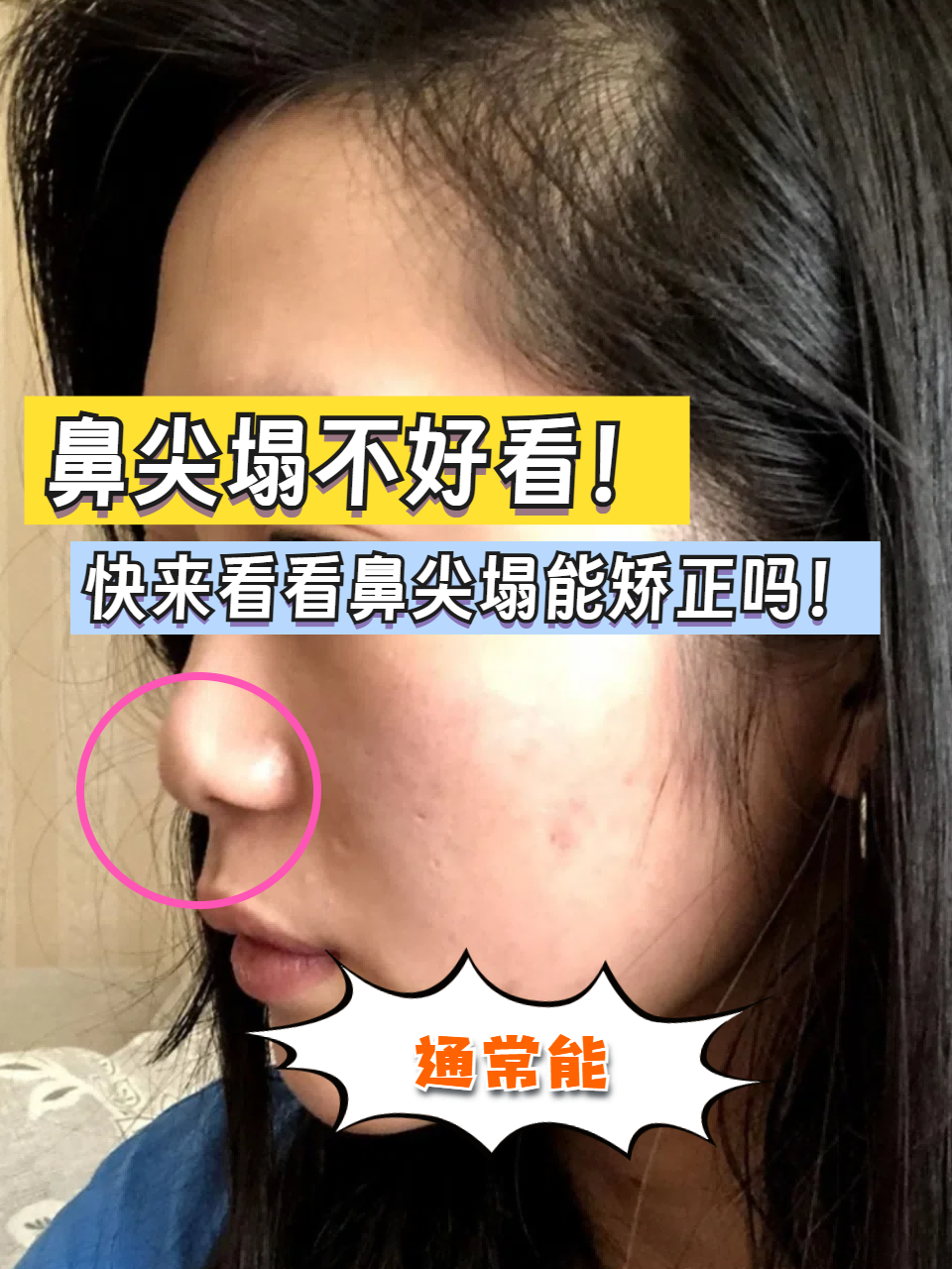 快来看看鼻尖塌能矫正吗!