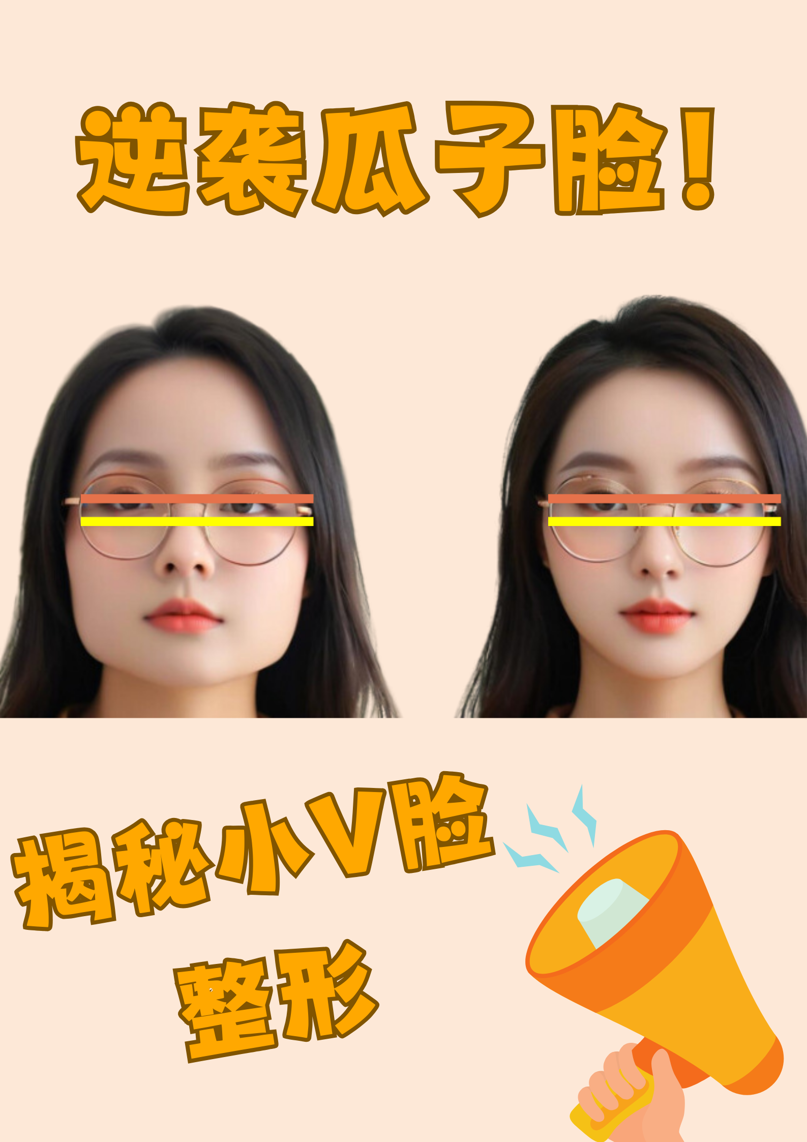 塑造小v脸轮廓的面部整形技术,包括注射肉毒素,面部吸脂术以及面部