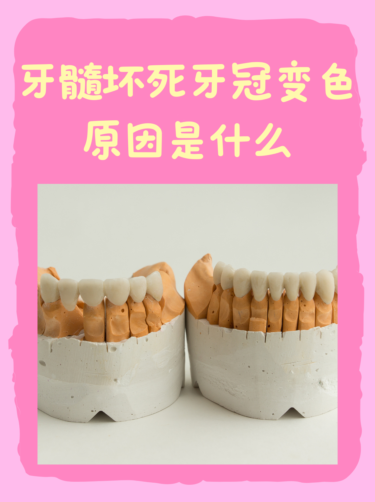 牙髓坏死牙冠变色的原因是什么?