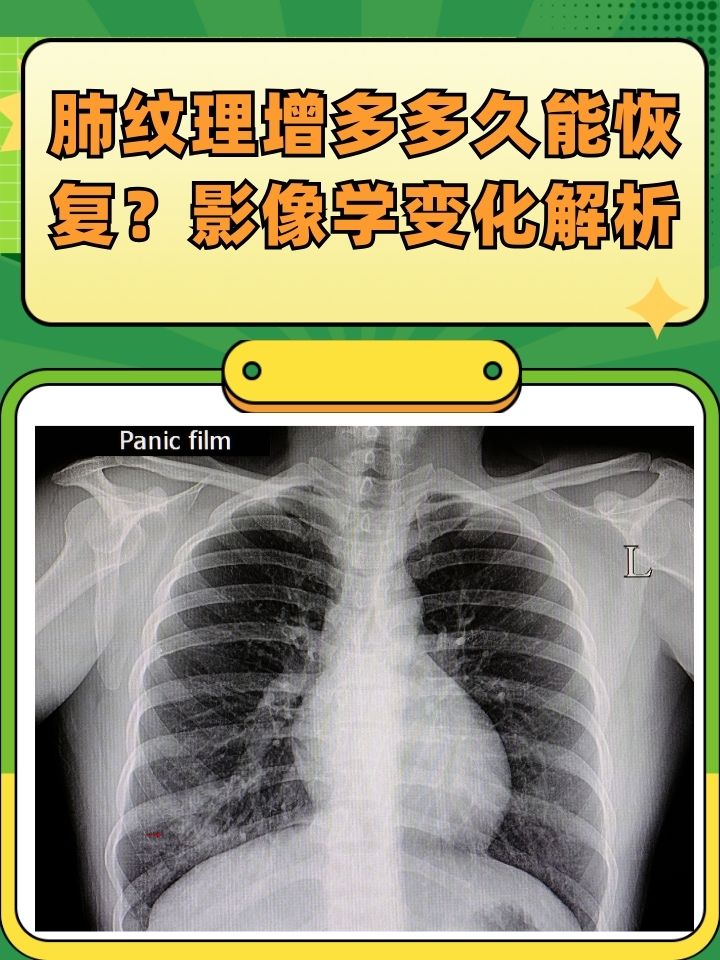 肺纹理增多多久能恢复?