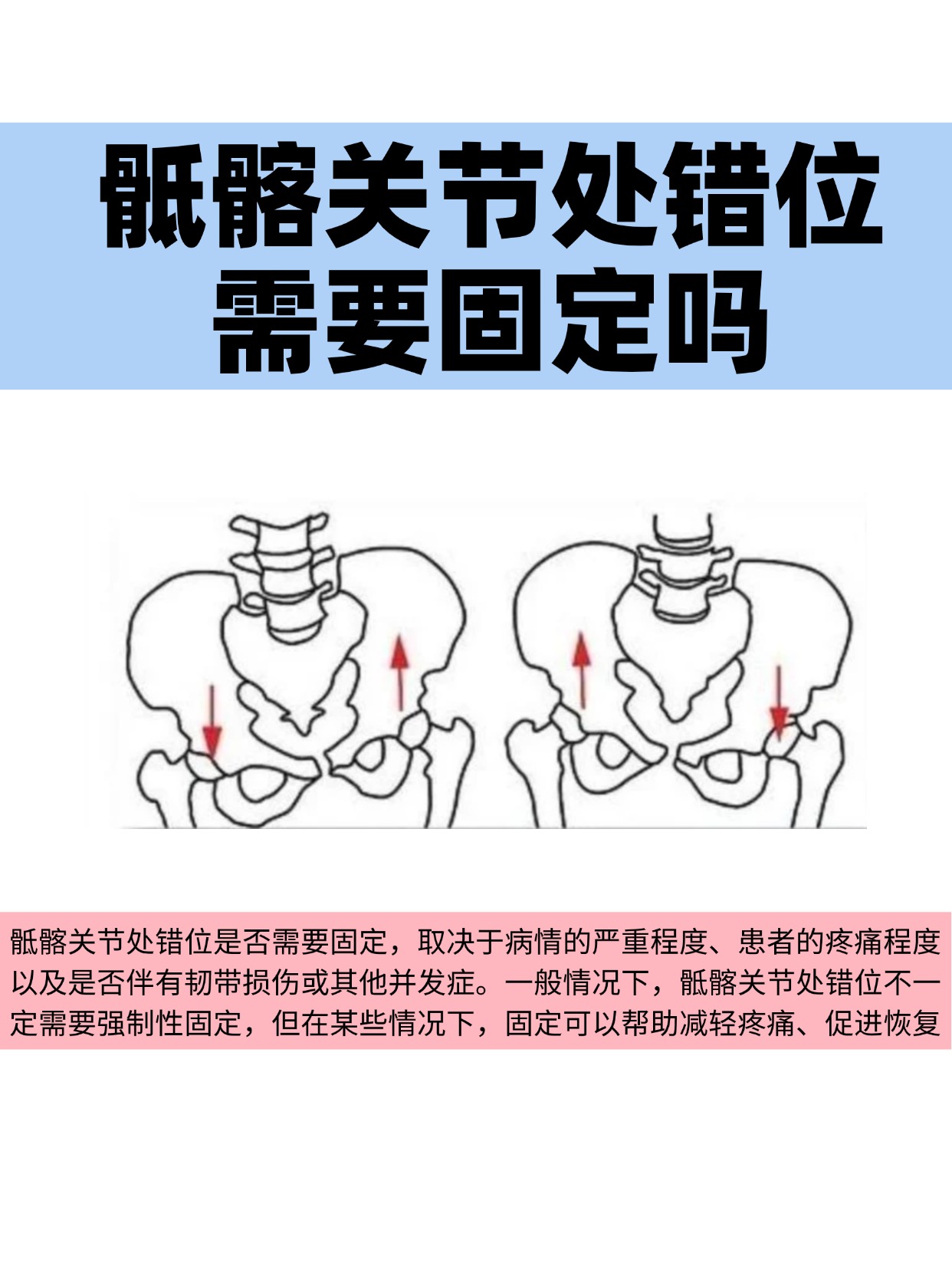 髂骨斜位拍摄方法图片