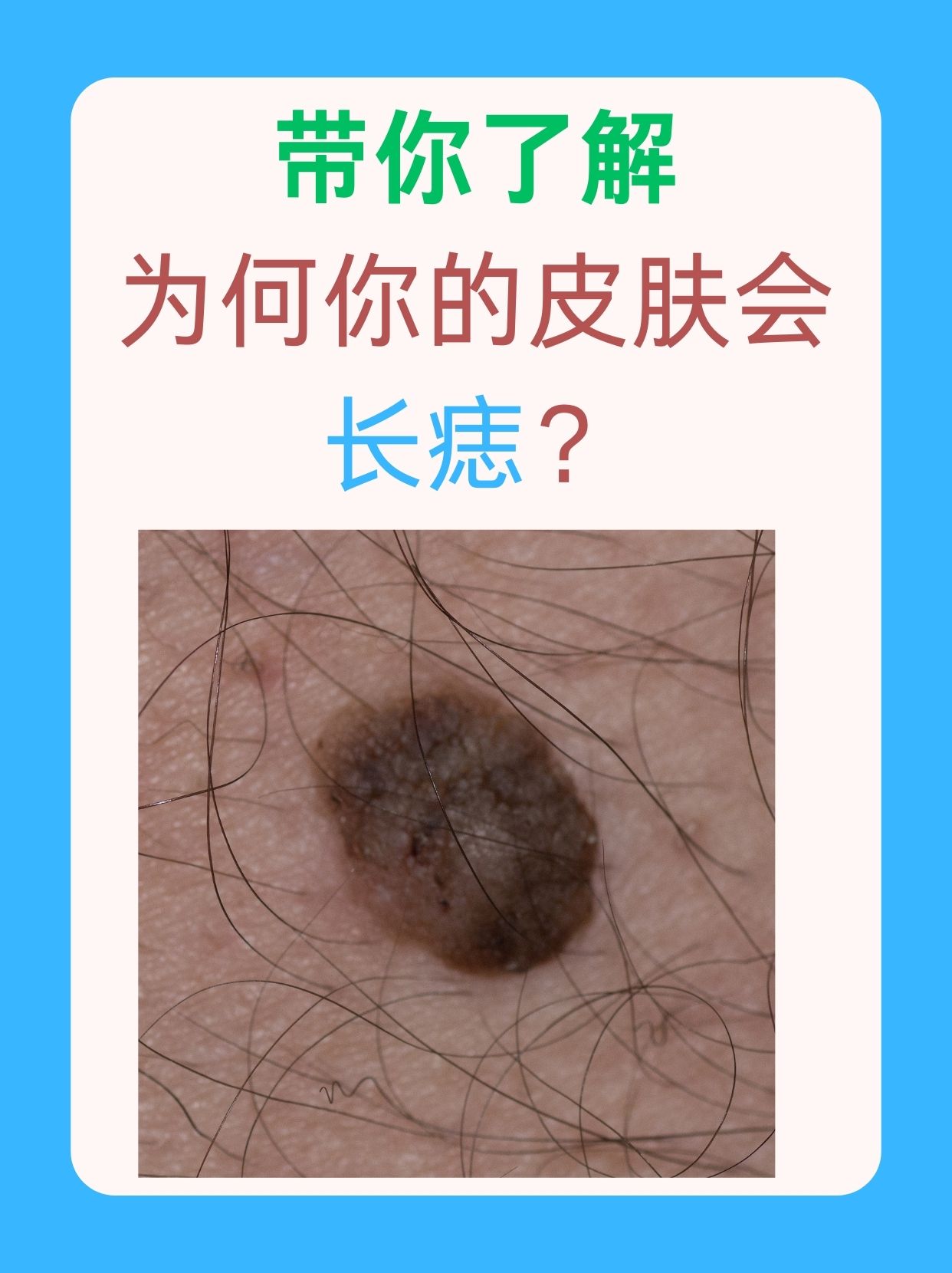 为什么会长痦子 为什么会长痦子