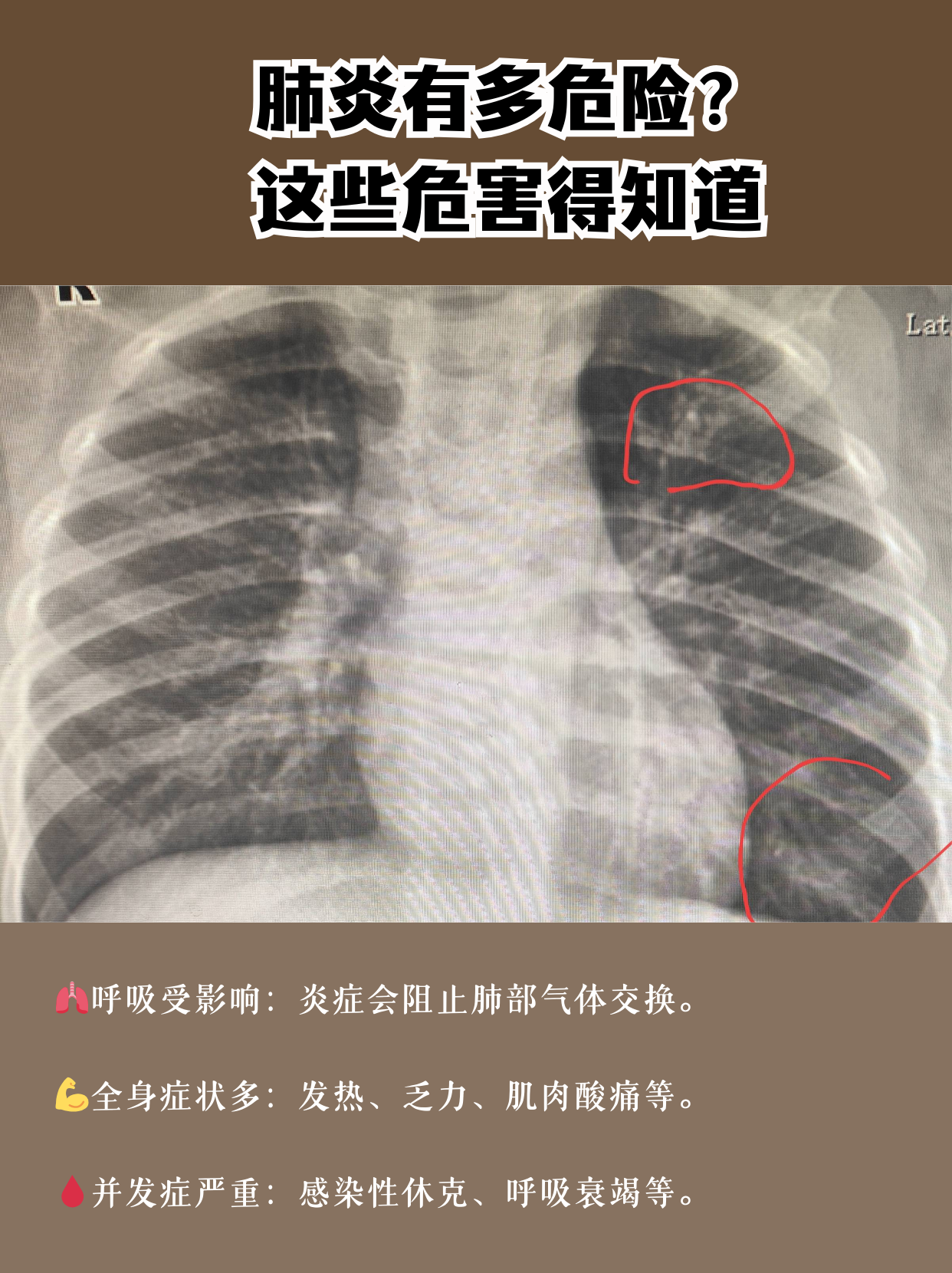 肺炎可不是小病,它对身体的影响不容小觑