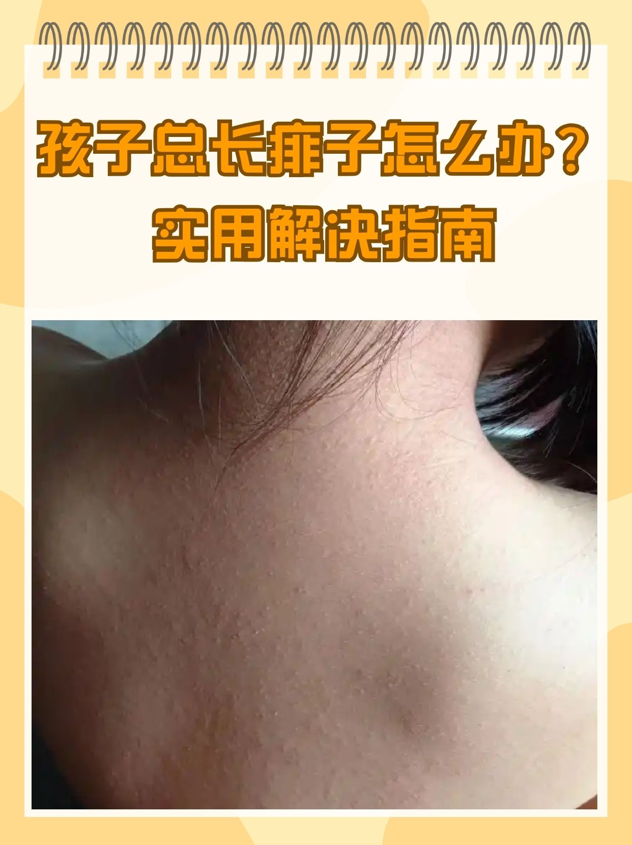 腋下,腹股沟等皮肤褶皱处,带来瘙痒和刺痛感,影响宝痱子冬天孩子会起