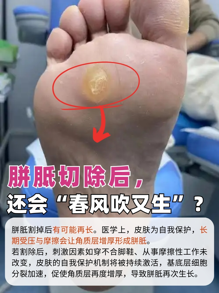 胼胝切除后,还会"春风吹又生"?