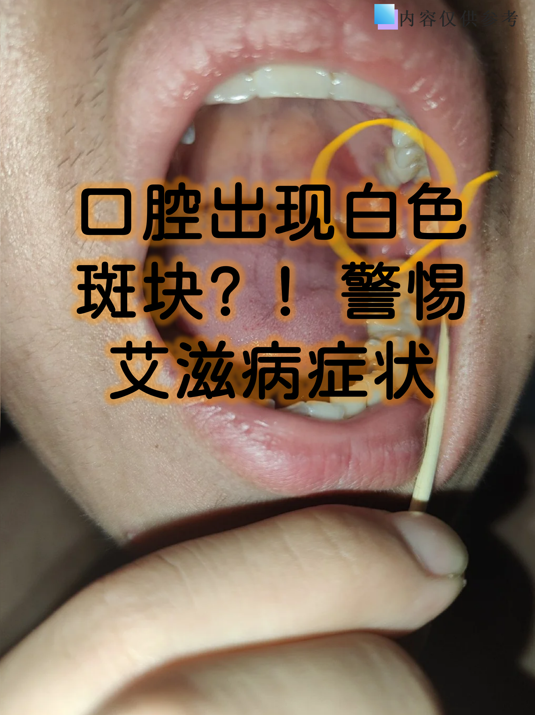 口腔出现白色斑块?