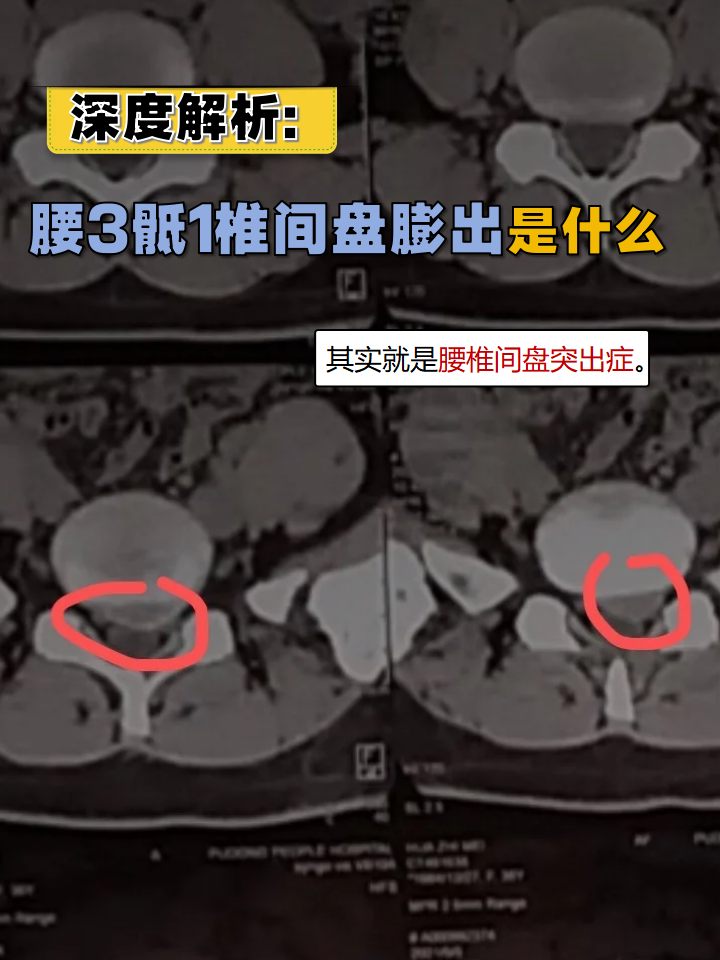深度解析:腰3骶1椎间盘膨出是什么