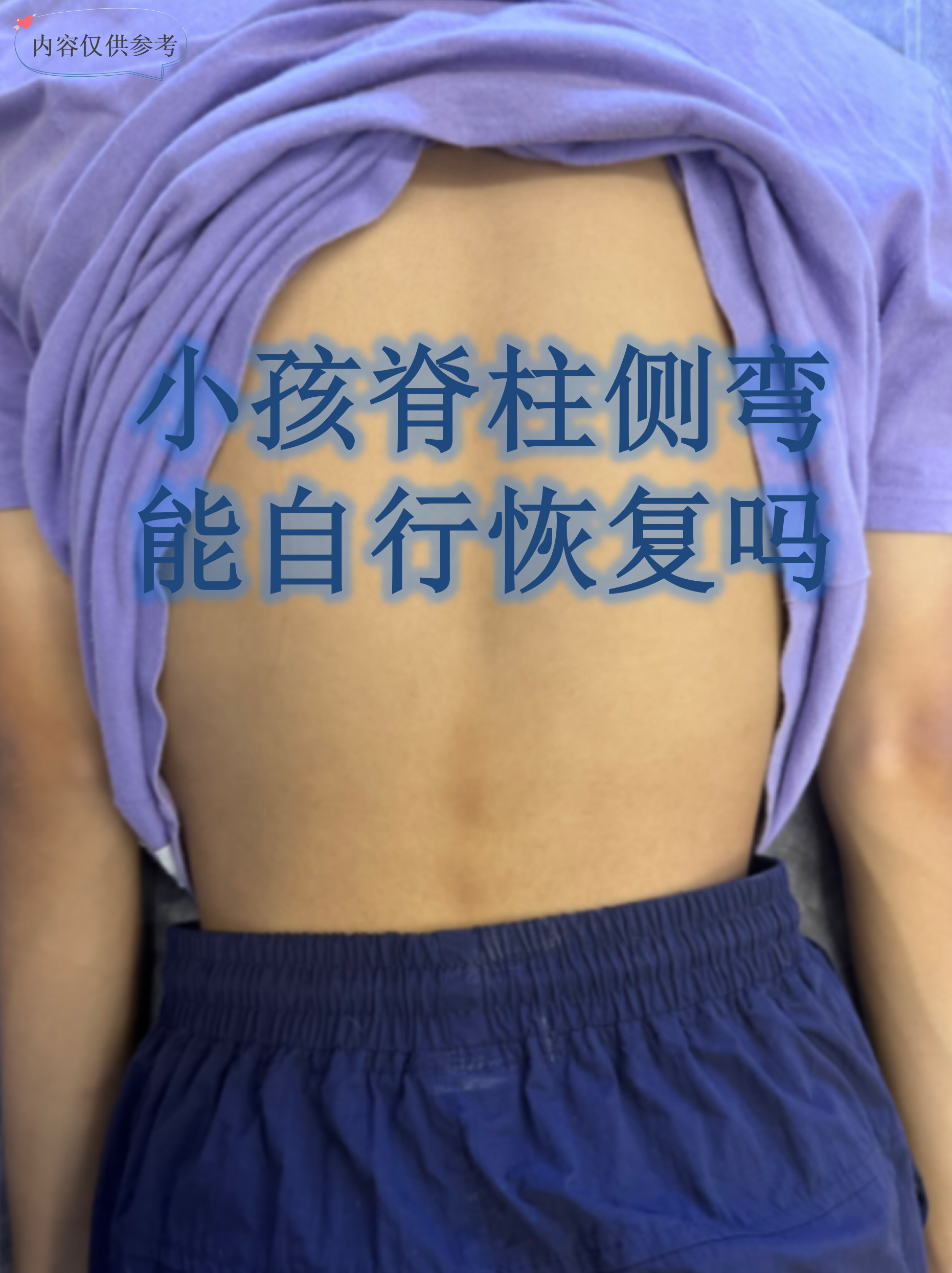 小孩脊柱侧弯能自行恢复吗