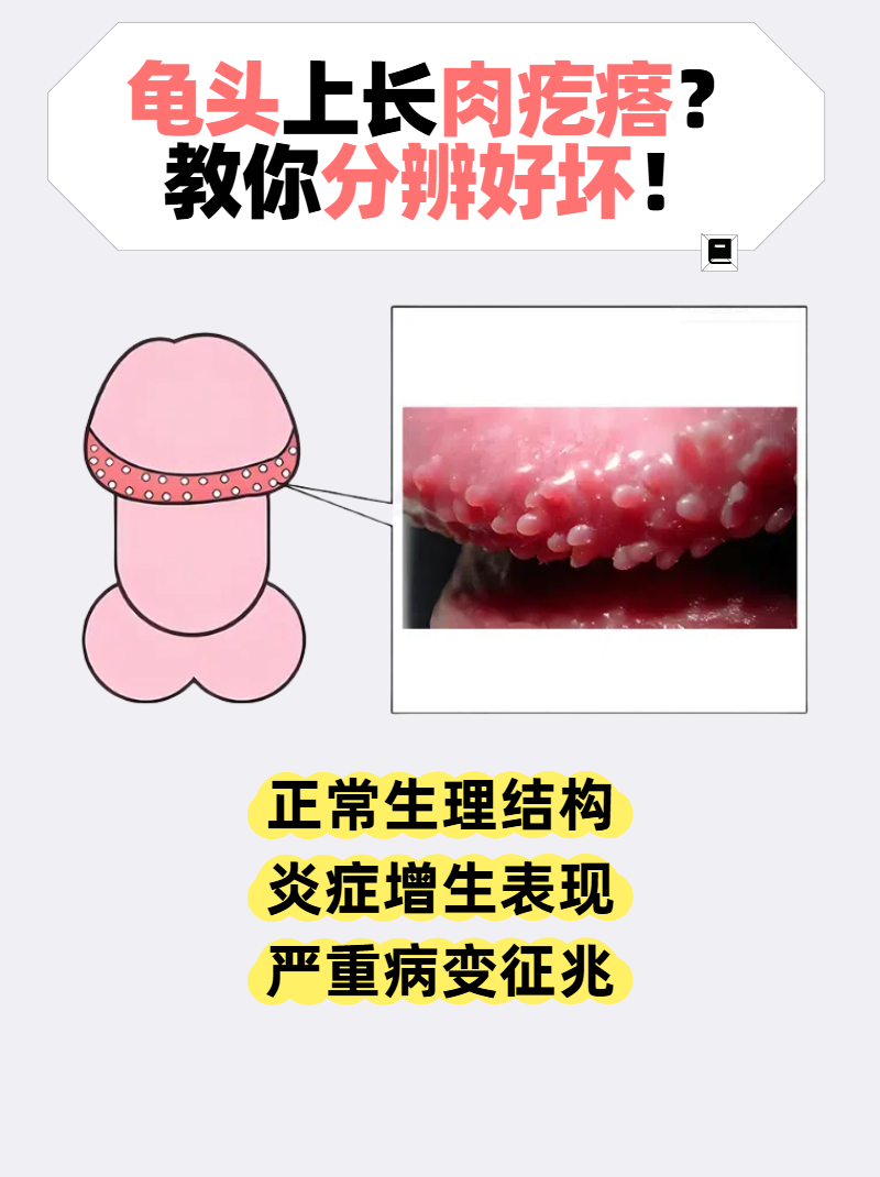 龟头上长肉疙瘩?教你分辨好坏!
