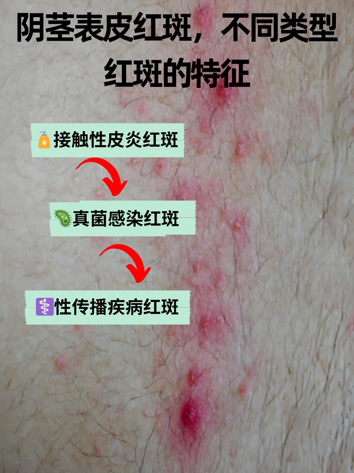 阴茎表皮红斑,不同类型红斑的特征