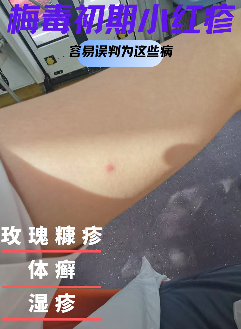 梅毒初期小红疹悄无声息出现,因症状不典型常被