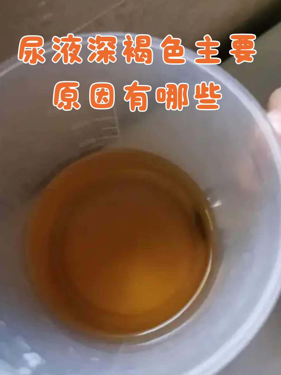 尿液深褐色主要原因有哪些