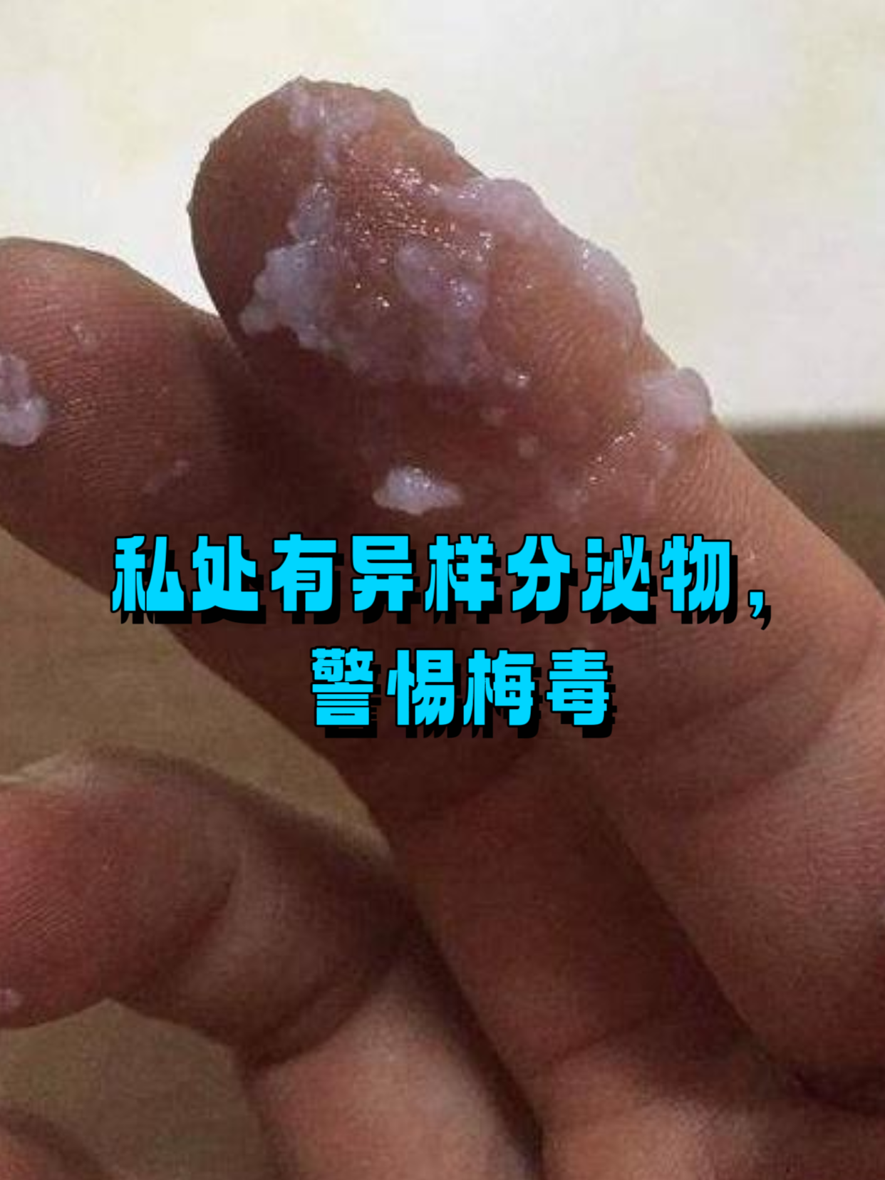私处有异样分泌物,警惕梅毒