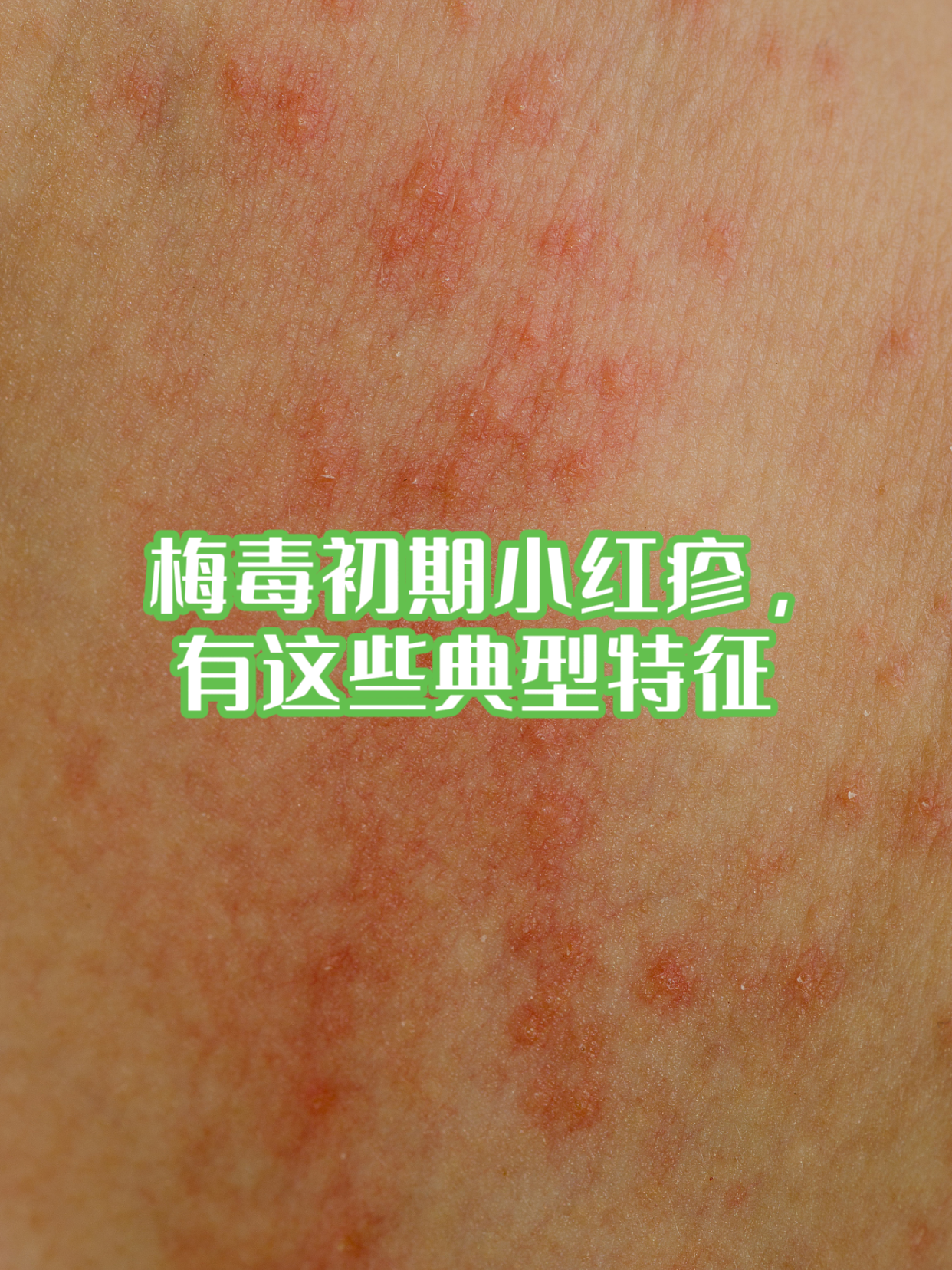 梅毒初期小红疹,有这些典型特征