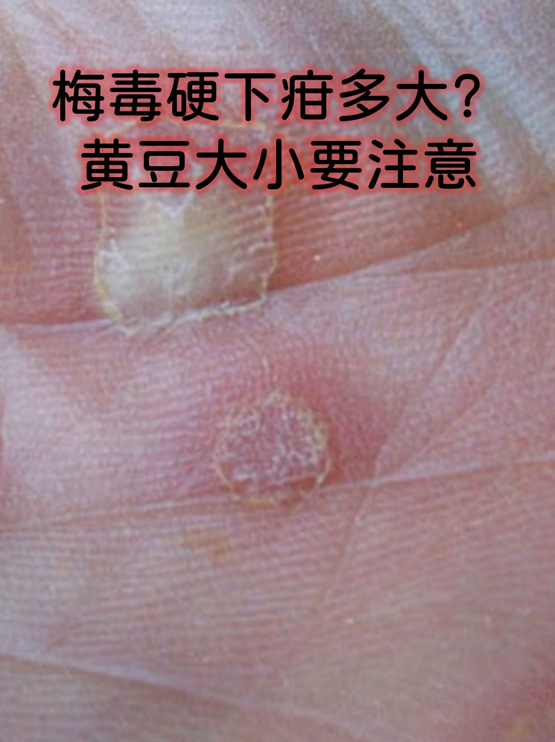 梅毒硬下疳的大小其实因人而异,但典型的硬下疳通常