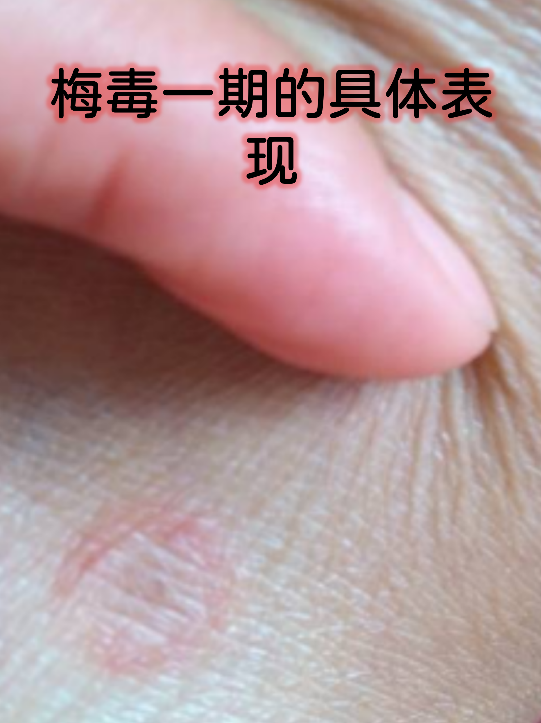 一期梅毒典型表现 硬下疳:感染部位出现无痛性溃疡