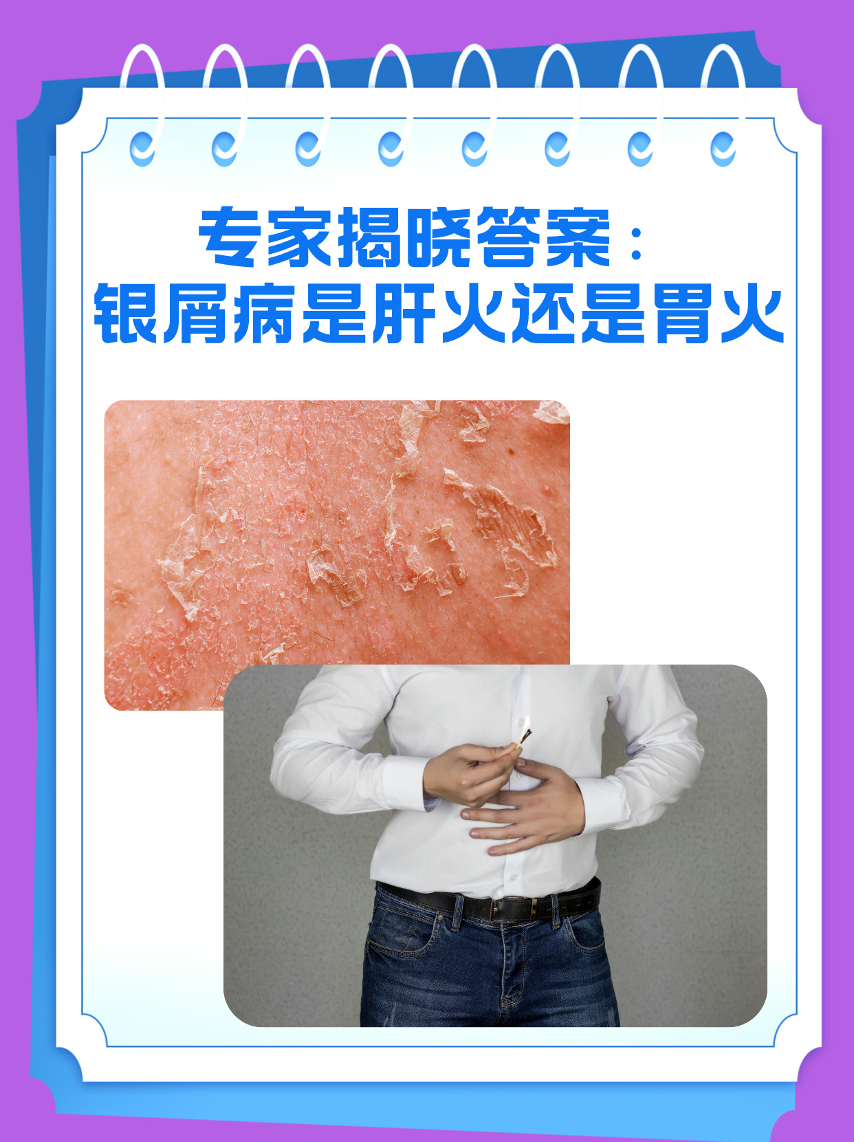 妈妈后天得银屑病会遗传吗(妈妈有银屑病会遗传吗)