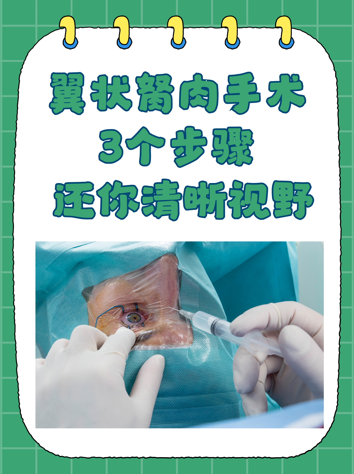 别担心,专业的翼状胬肉手术可以切除眼睛表面的翼状胬肉组织,以改善