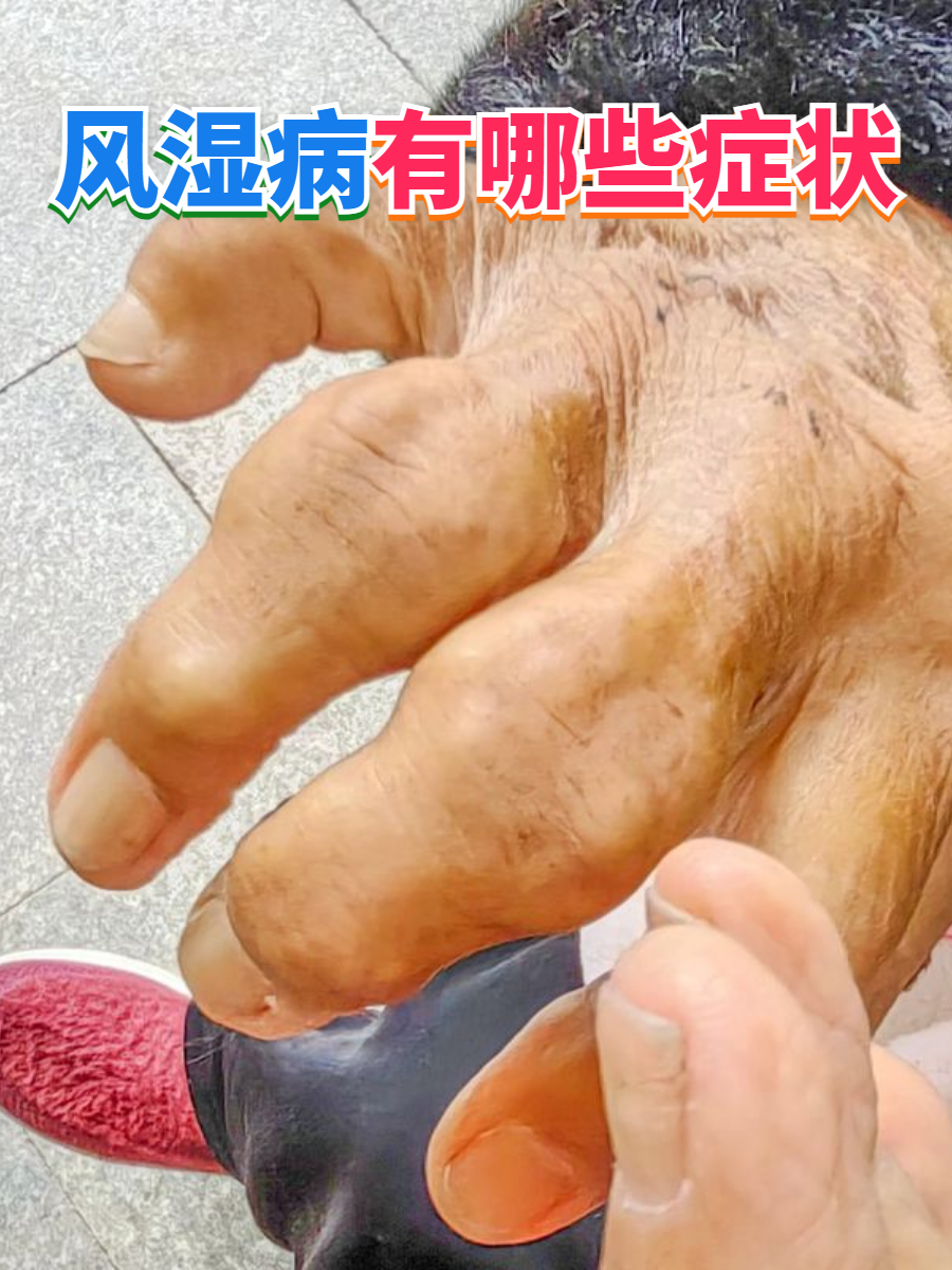 风湿病是一大类疾病的总称,常见症状包括关节疼痛
