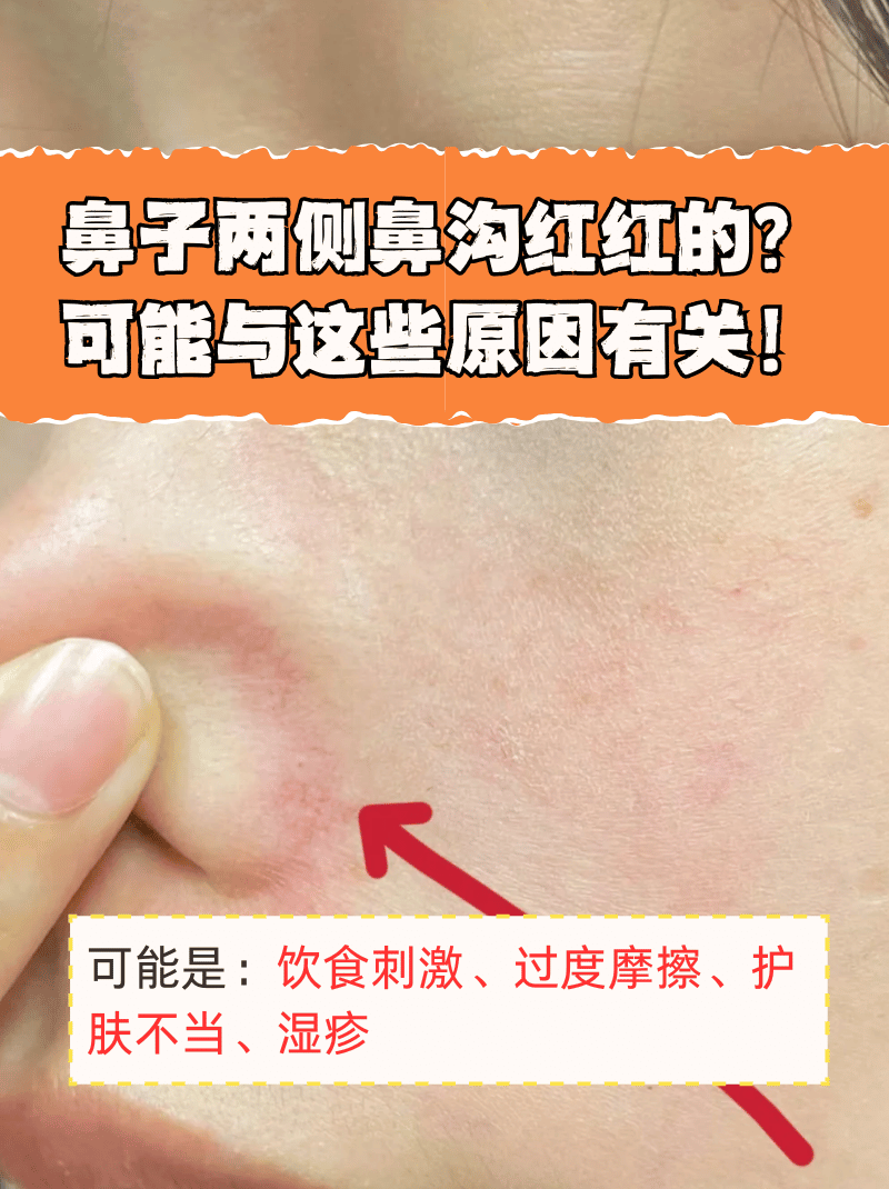 皮怎么治疗鼻子两侧根部鼻沟发红鼻子两侧发红怎么回事鼻子两沟红红的