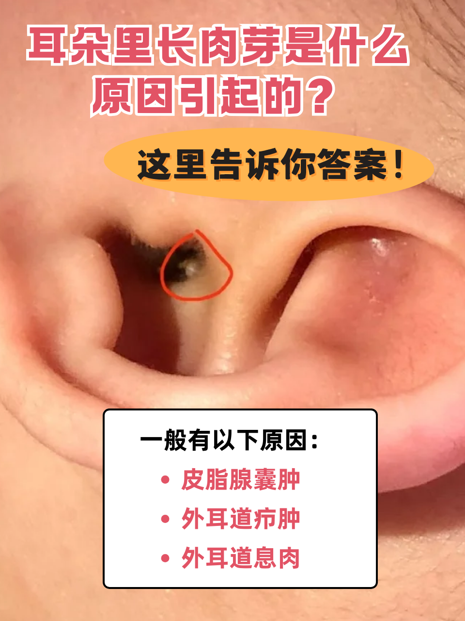 耳朵是我们重要的听觉器官,如果耳朵里出现了长肉芽的情况