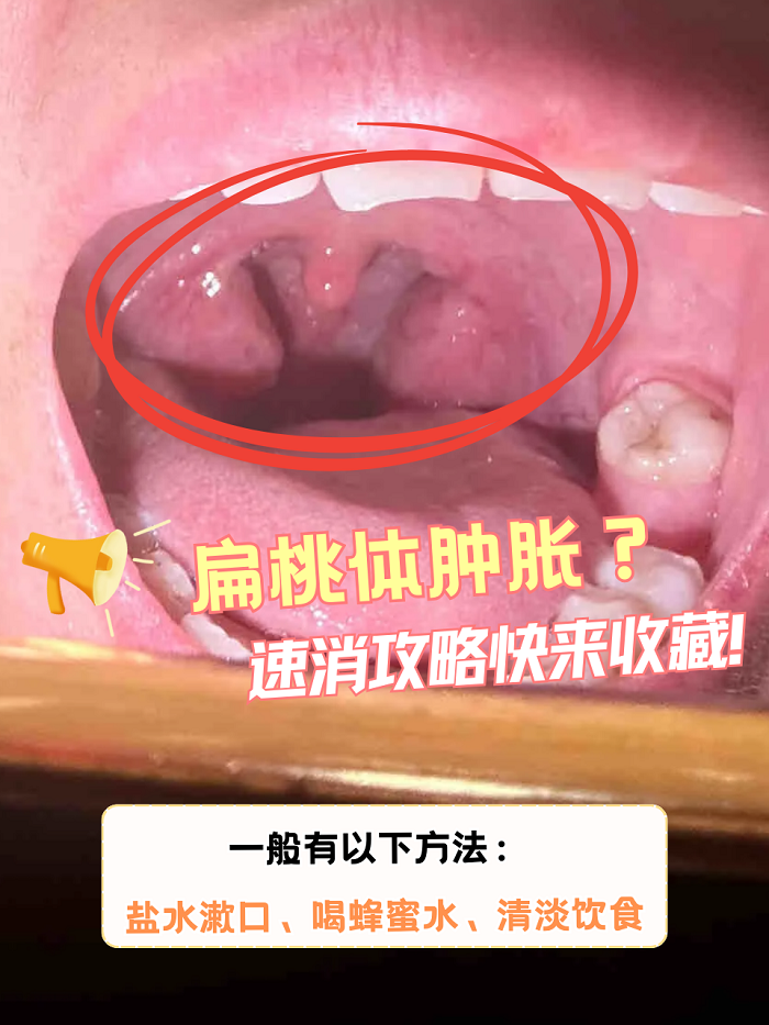 扁桃体如果出现了肿胀的情况,可能会引起吞咽困难,疼痛等