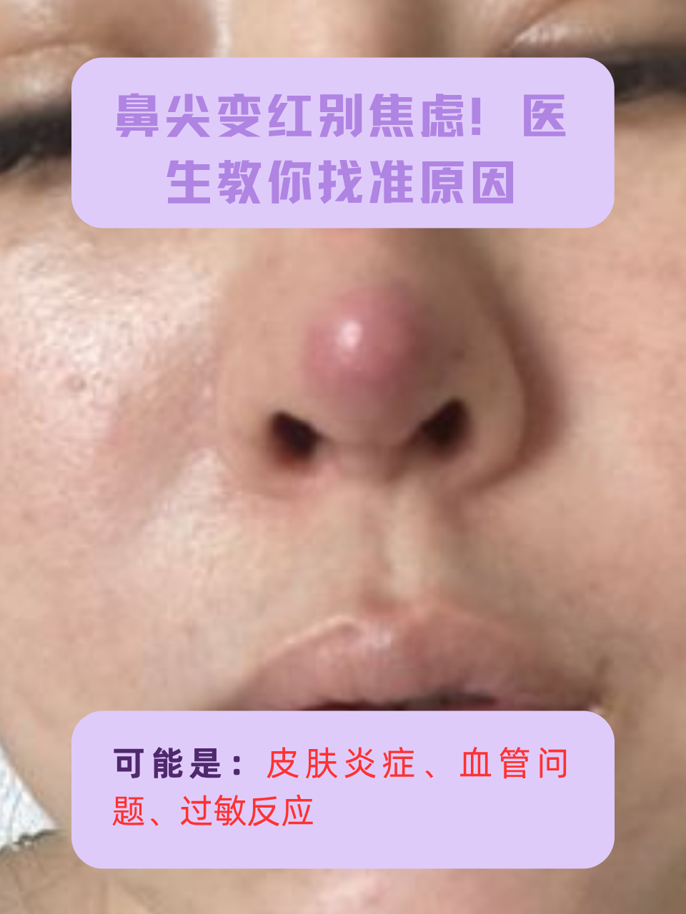 鼻尖发红可能由皮肤炎症,血管扩张,过敏反应等多种原因引起