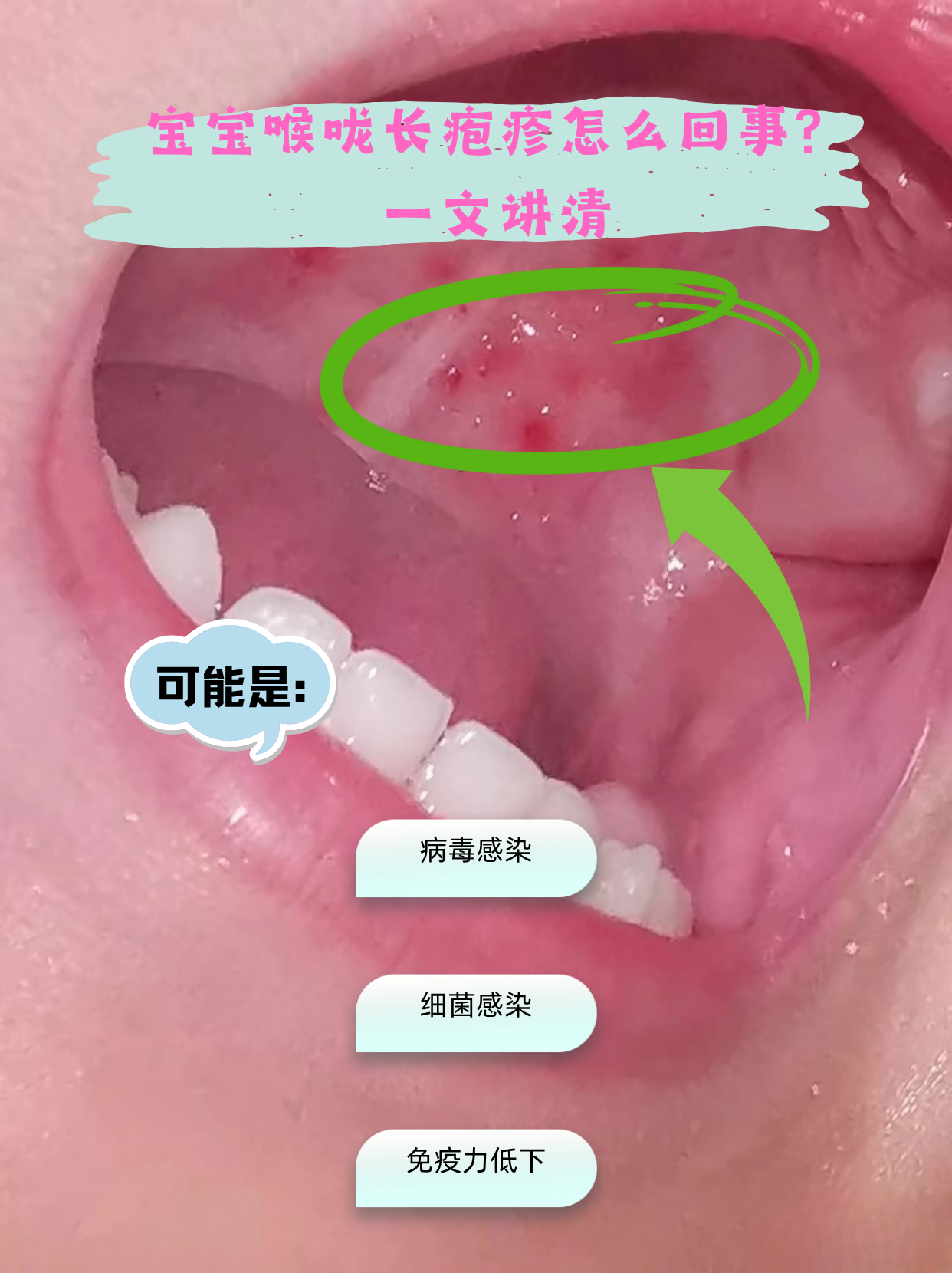 一文讲清  宝宝喉咙长疱疹,多由病毒感染引起,常见如疱疹性咽峡炎