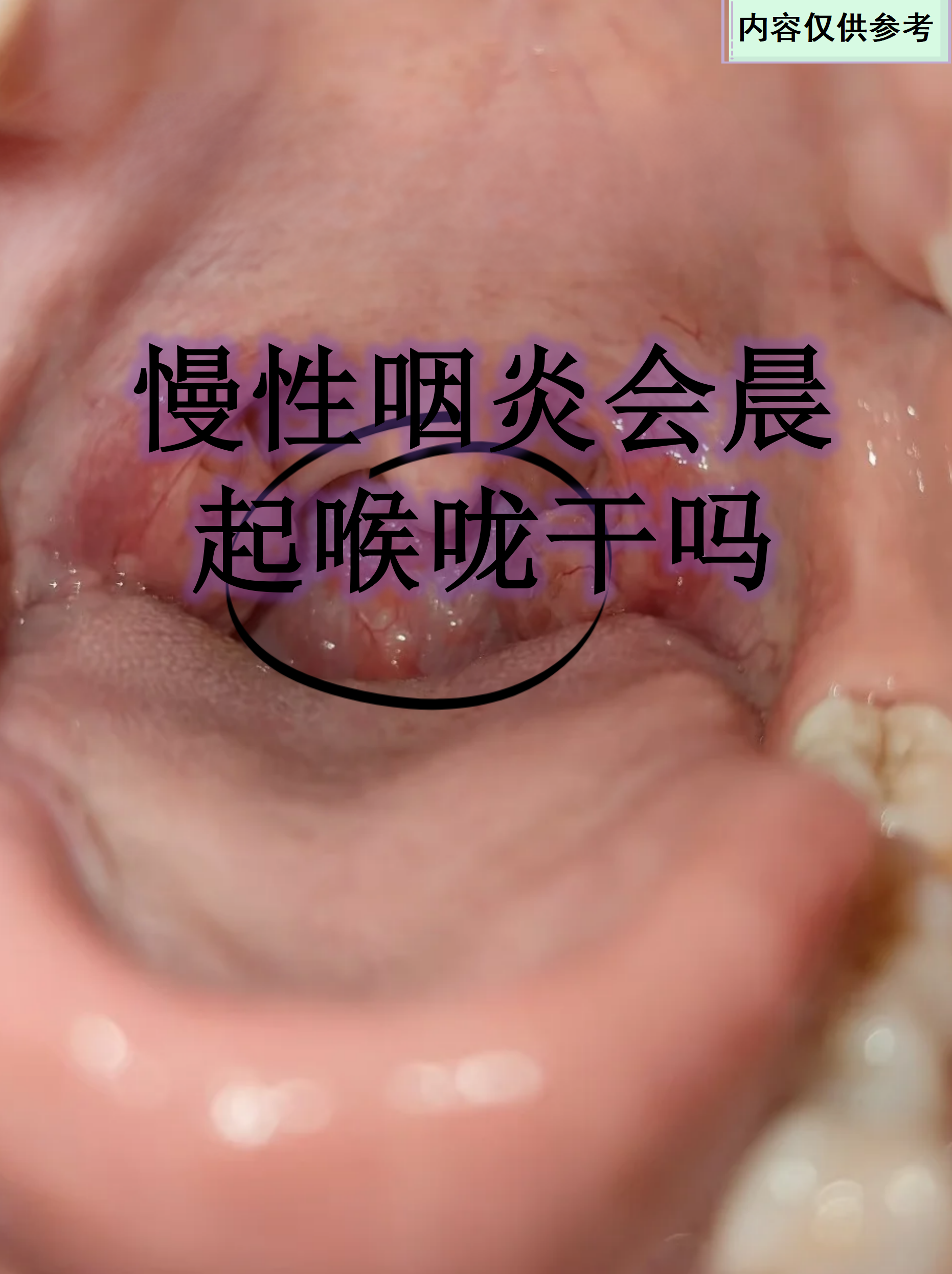 慢性咽炎会晨起喉咙干吗