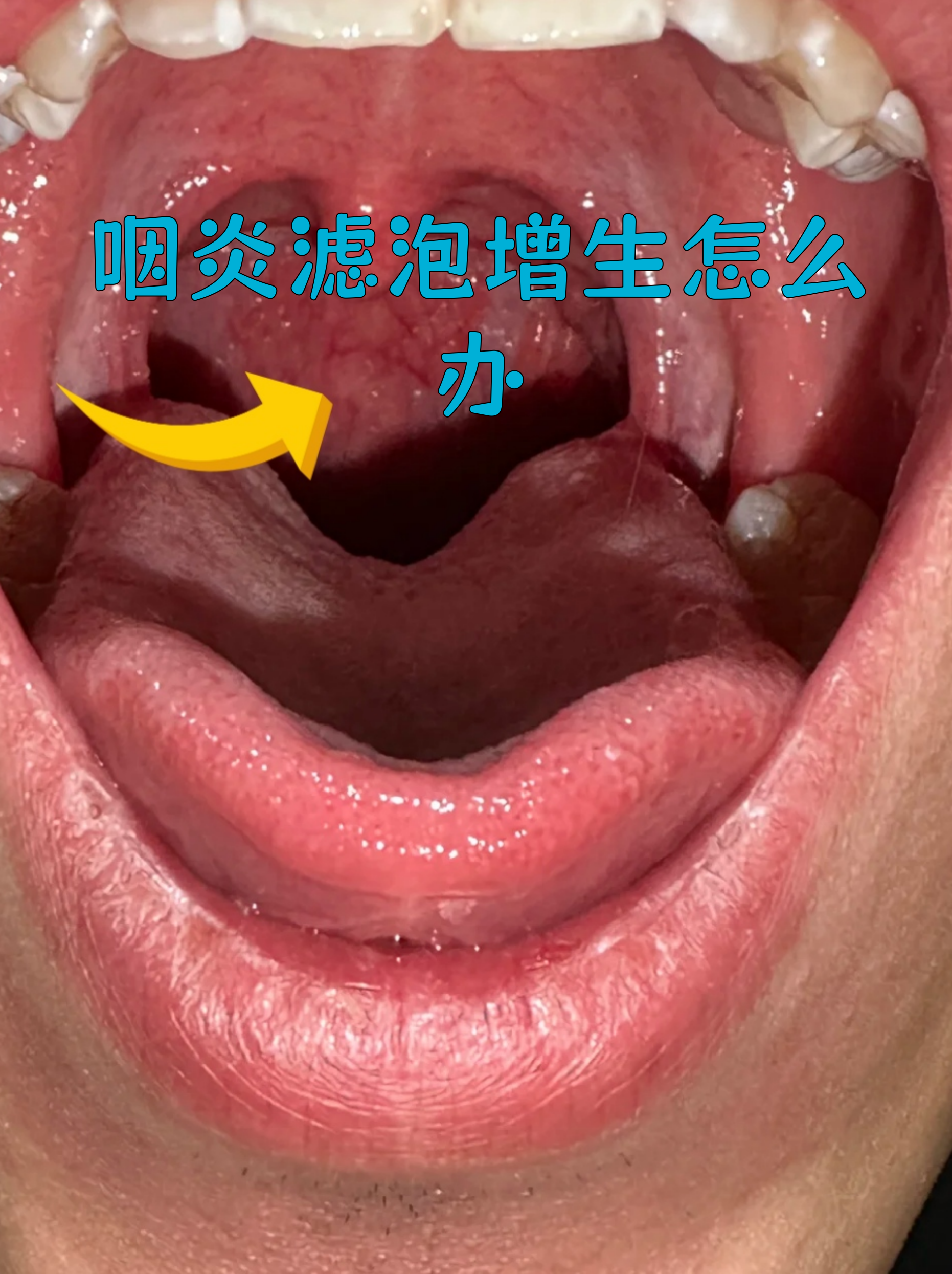 咽喉后壁的淋巴滤泡增生是慢性咽炎的典型表现