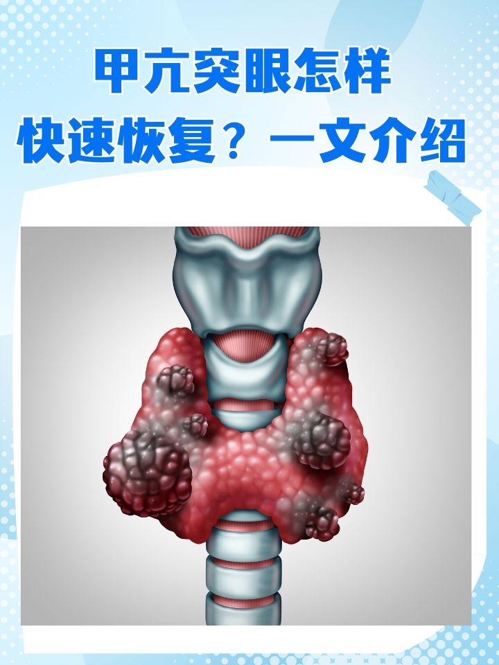 甲亢突眼怎样快速恢复?