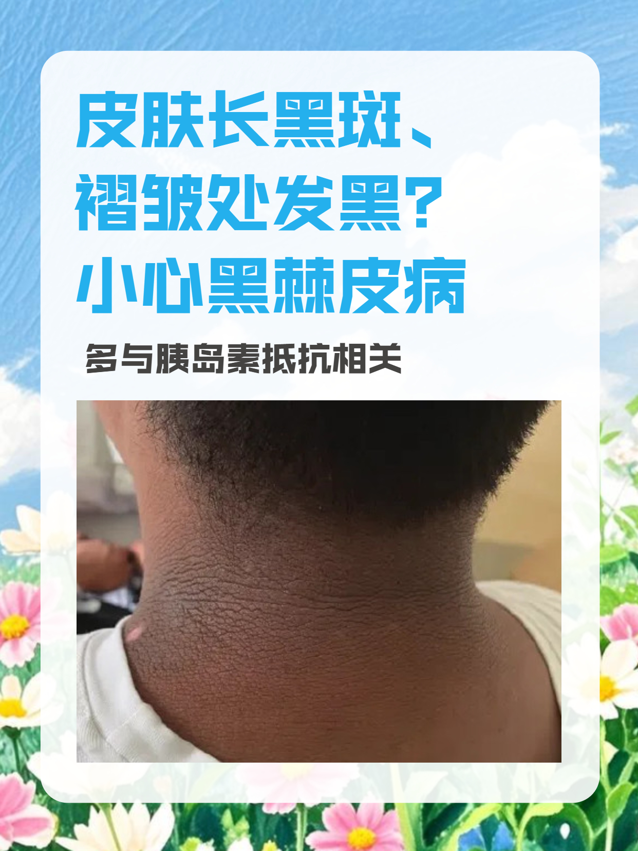 皮肤长黑斑褶皱处发黑?