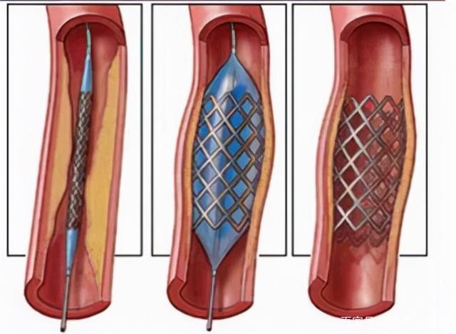 心脏支架位置图片