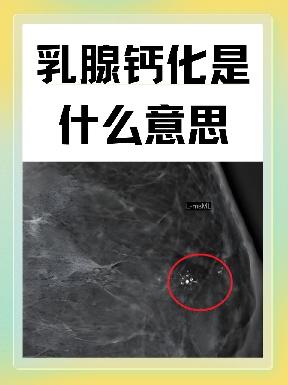 乳腺点状钙化图片