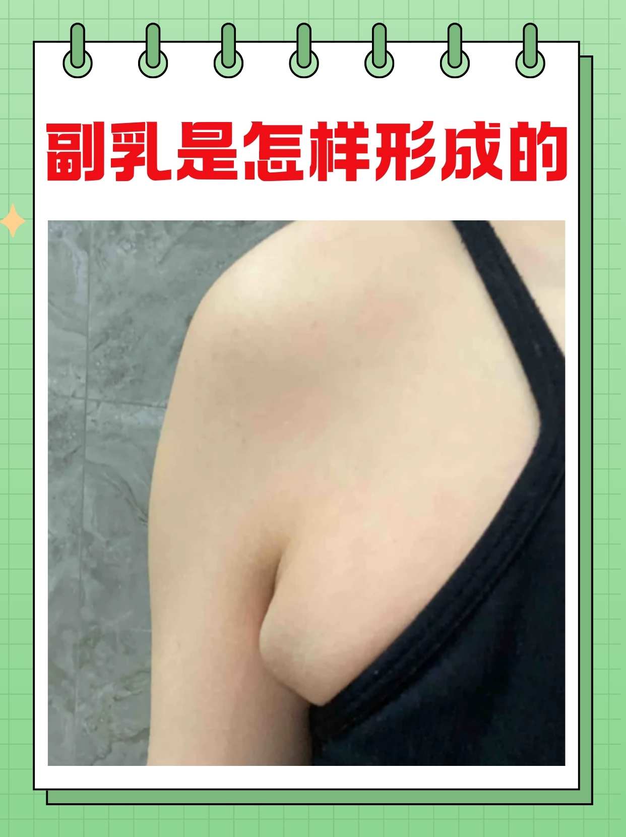 副乳是什么及其图片图片