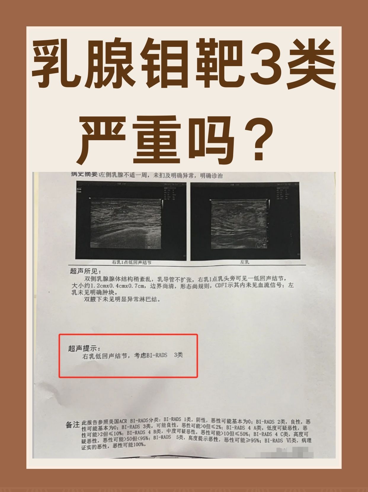 当检查结果显示为乳腺钼靶3类时,很多人会感到担忧和困惑:乳腺钼靶3类