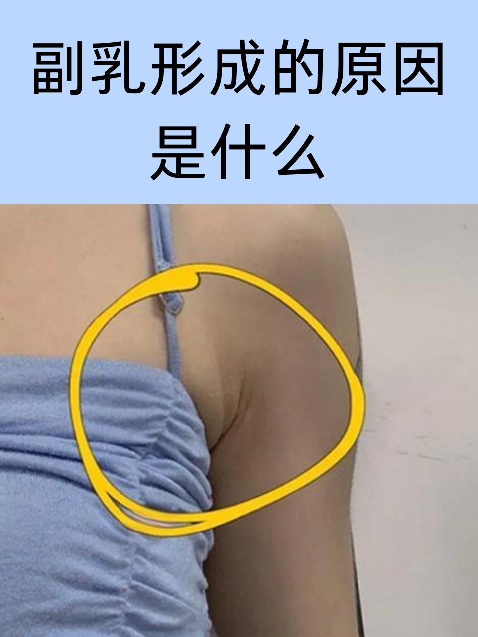 怎么判断是否有副乳图片