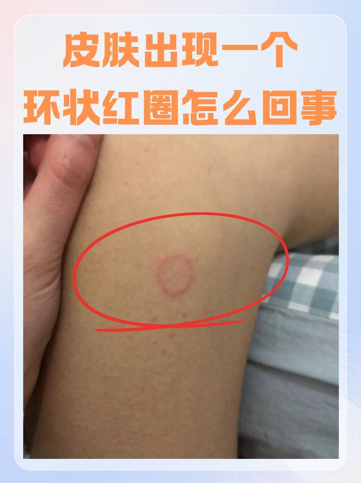 那么,皮肤环状红圈究竟是怎么回事?这篇文章带你了解