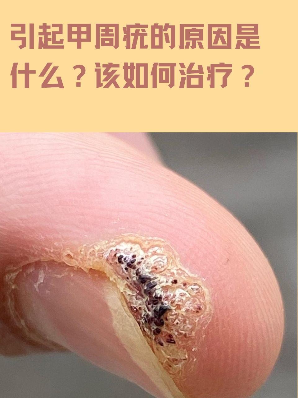甲周疣,这个不太为人熟知的皮肤问题,却给很多人带来了困扰,下面